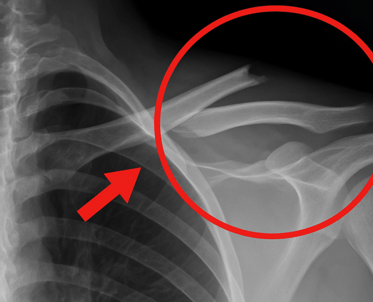 osdetruit e1747313572755 Vous buvez sûrement cette boisson chaque jour… mais elle détruit vos os !