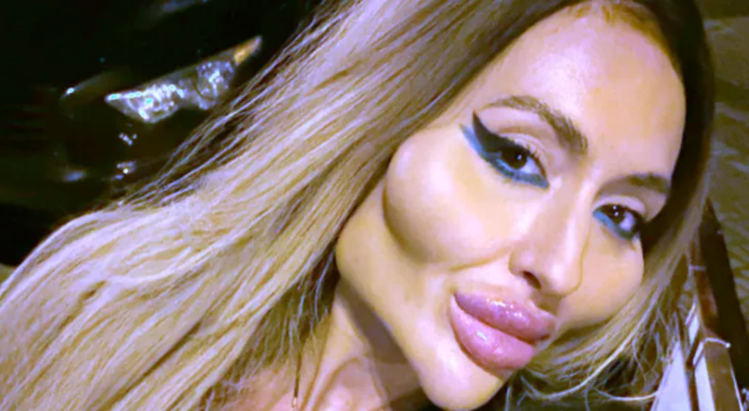 La femme aux plus grandes pommettes du monde choque encore : elle passe une nouvelle fois sous les aiguilles ! (VIDÉO) 1 La femme aux plus grandes pommettes du monde choque encore : elle passe une nouvelle fois sous les aiguilles ! (VIDÉO) Capture decran 2025 06 30 045738 La femme aux plus grandes pommettes du monde choque encore : elle passe une nouvelle fois sous les aiguilles ! (VIDÉO)