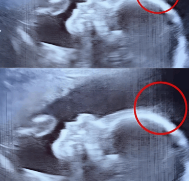 Ce que l’échographie a révélé a stupéfait tout le monde… et la naissance de Holly a confirmé l’incroyable ! 3 Ce que l’échographie a révélé a stupéfait tout le monde… et la naissance de Holly a confirmé l’incroyable ! ecograhie petite Ce que l’échographie a révélé a stupéfait tout le monde… et la naissance de Holly a confirmé l’incroyable !