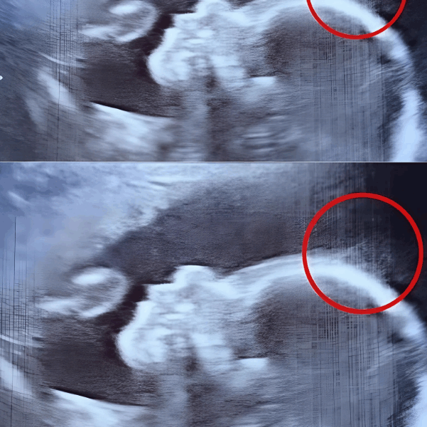 ecograhie petite Ce que l’échographie a révélé a stupéfait tout le monde… et la naissance de Holly a confirmé l’incroyable !