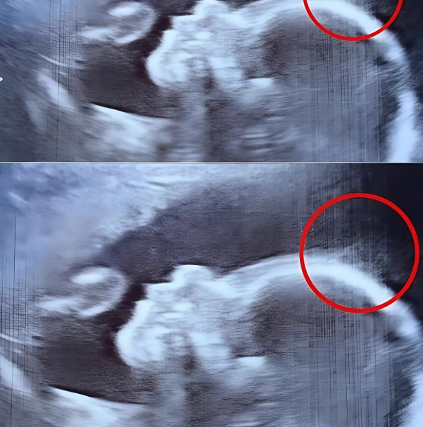 Ce que l’échographie a révélé a stupéfait tout le monde… et la naissance de Holly a confirmé l’incroyable ! 1 Ce que l’échographie a révélé a stupéfait tout le monde… et la naissance de Holly a confirmé l’incroyable ! ecograhie petite Ce que l’échographie a révélé a stupéfait tout le monde… et la naissance de Holly a confirmé l’incroyable !