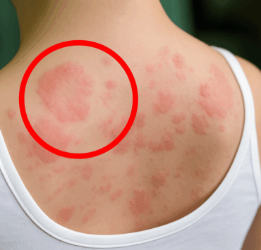 Pourquoi l’urticaire surgit sans prévenir : les causes surprenantes que vous ignorez 3 Pourquoi l’urticaire surgit sans prévenir : les causes surprenantes que vous ignorez urtic e1751031553587 Pourquoi l’urticaire surgit sans prévenir : les causes surprenantes que vous ignorez