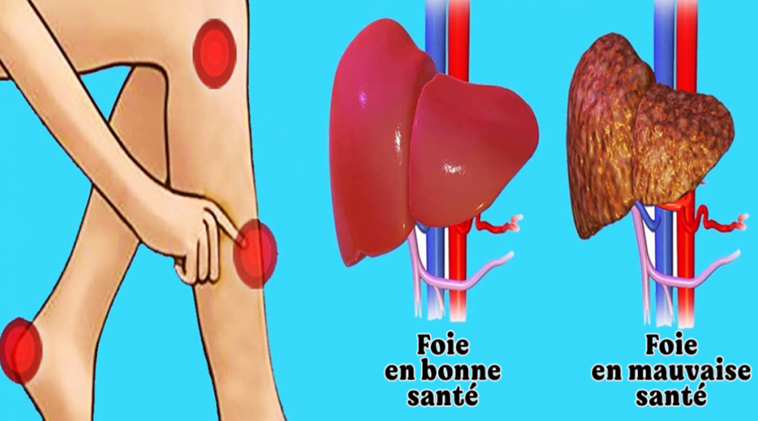 Oui, le corps prévient lorsque le foie va mal : 5 symptômes à identifier 1 Oui, le corps prévient lorsque le foie va mal : 5 symptômes à identifier Capture decran 2025 07 05 052607 Oui, le corps prévient lorsque le foie va mal : 5 symptômes à identifier