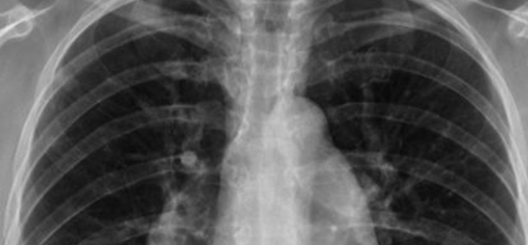 Capture decran 2025 07 14 041649 Ce poison quotidien qui fragilise vos os sans que vous le sachiez