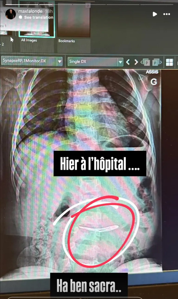 Capture decran 2025 08 11 140058 Max Lalonde raconte avec humour la frayeur causée par un objet insolite avalé par sa fille