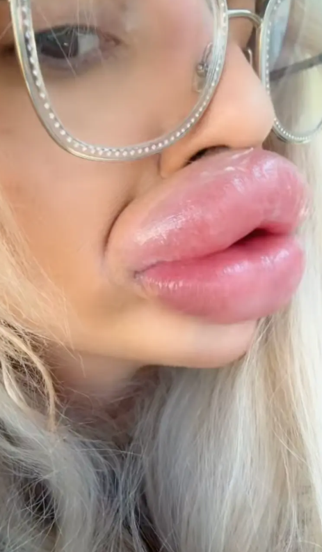 Capture decran 2025 08 15 064827 L’influenceuse aux lèvres XXL qui ne peut plus les fermer choque et fascine