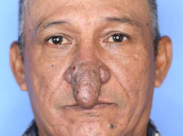 Un nez hors du commun sublimé par la chirurgie : découvrez le résultat spectaculaire 4 Un nez hors du commun sublimé par la chirurgie : découvrez le résultat spectaculaire Un nez hors du commun sublimé par la chirurgie : découvrez le résultat spectaculaire