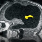 Un cerveau réduit à 10 % : le cas fascinant de ce Français qui vivait comme tout le monde 13 Un cerveau réduit à 10 % : le cas fascinant de ce Français qui vivait comme tout le monde Capture decran 24 10 2025 22027 www.facebook.com Un cerveau réduit à 10 % : le cas fascinant de ce Français qui vivait comme tout le monde