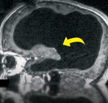 Un cerveau réduit à 10 % : le cas fascinant de ce Français qui vivait comme tout le monde 2 Un cerveau réduit à 10 % : le cas fascinant de ce Français qui vivait comme tout le monde Capture decran 24 10 2025 22027 www.facebook.com Un cerveau réduit à 10 % : le cas fascinant de ce Français qui vivait comme tout le monde