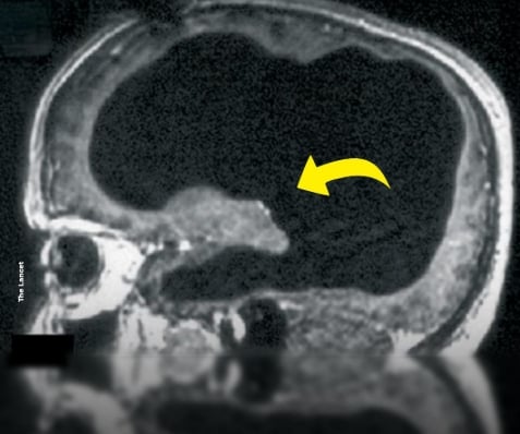 Un cerveau réduit à 10 % : le cas fascinant de ce Français qui vivait comme tout le monde 1 Un cerveau réduit à 10 % : le cas fascinant de ce Français qui vivait comme tout le monde Capture decran 24 10 2025 22027 www.facebook.com Un cerveau réduit à 10 % : le cas fascinant de ce Français qui vivait comme tout le monde