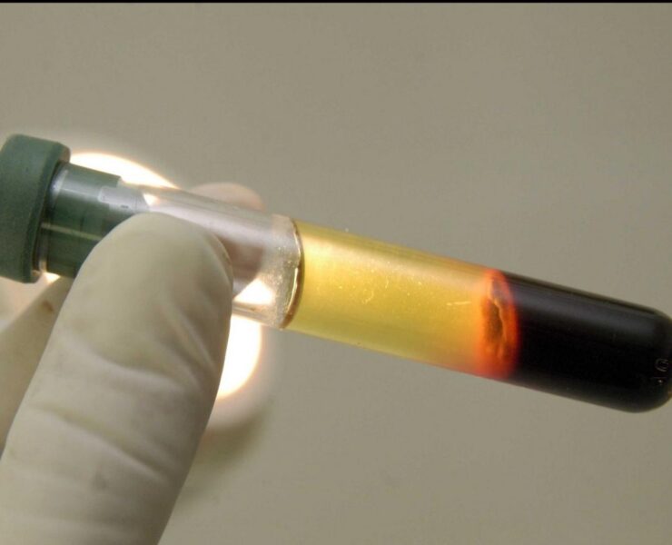 cover r4x3w1200 675ab97b18fab sipa 00518293 000004 « Mauvais » cholestérol : la clé génétique derrière son accumulation enfin découverte