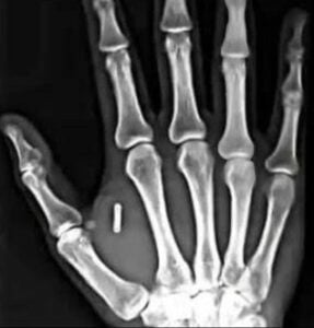 Des milliers de personnes se font implanter des micropuces pour remplacer les clés, les cartes et les documents personnels. 4 Des milliers de personnes se font implanter des micropuces pour remplacer les clés, les cartes et les documents personnels. Capture decran 11 11 2025 223351 www.bing .com Des milliers de personnes se font implanter des micropuces pour remplacer les clés, les cartes et les documents personnels.