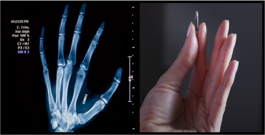 Des milliers de personnes se font implanter des micropuces pour remplacer les clés, les cartes et les documents personnels. 1 Des milliers de personnes se font implanter des micropuces pour remplacer les clés, les cartes et les documents personnels. JSE3 e1762919386393 Des milliers de personnes se font implanter des micropuces pour remplacer les clés, les cartes et les documents personnels.