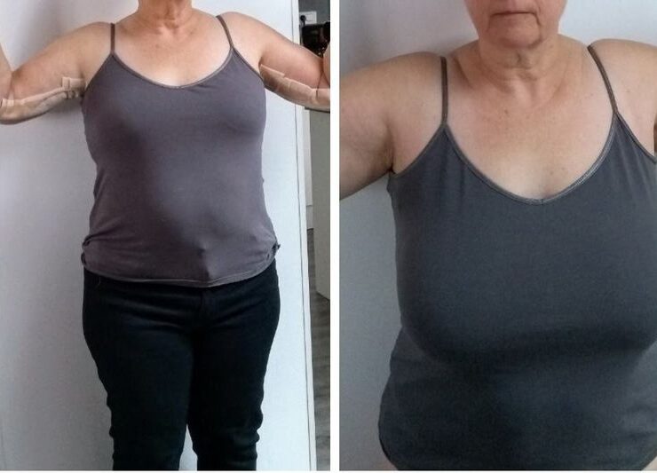 reduction mammaire tunisie photos avant apres Transformation spectaculaire : les photos parlent d’elles-mêmes