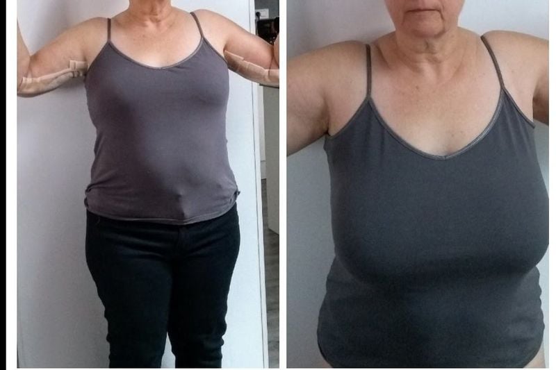 reduction mammaire tunisie photos avant apres Transformation spectaculaire : les photos parlent d’elles-mêmes