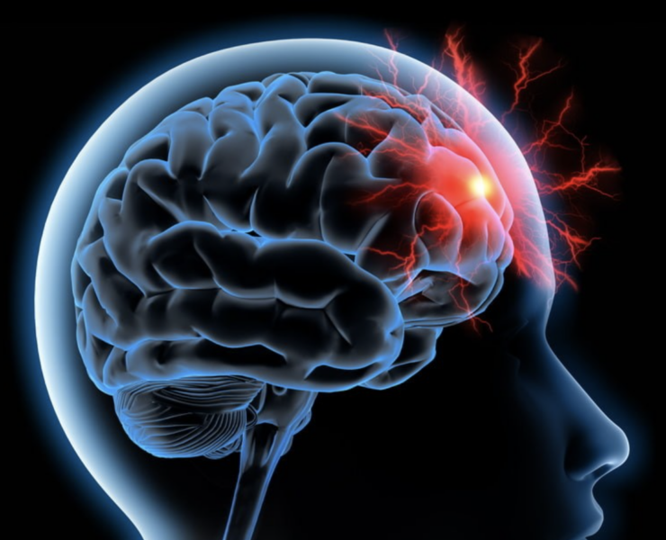 Capture decran le 2025 12 07 a 16.29.33 AVC : un danger encore sous-estim&eacute;, surtout chez les femmes