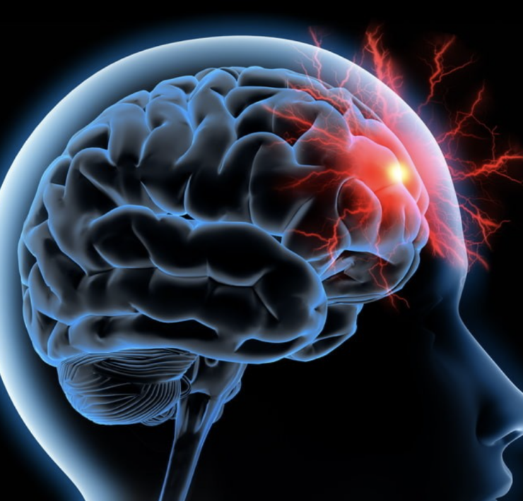 Capture decran le 2025 12 07 a 16.29.33 AVC : un danger encore sous-estim&eacute;, surtout chez les femmes