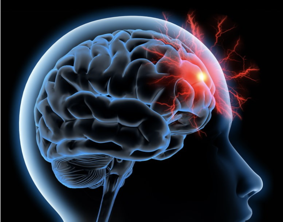 Capture decran le 2025 12 07 a 16.29.33 AVC : un danger encore sous-estim&eacute;, surtout chez les femmes