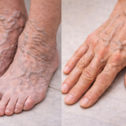 ChatGPT Image 24 dec. 2025 10 59 06 Si tes veines sont gonfl&eacute;es, voici ce que &ccedil;a peut indiquer...