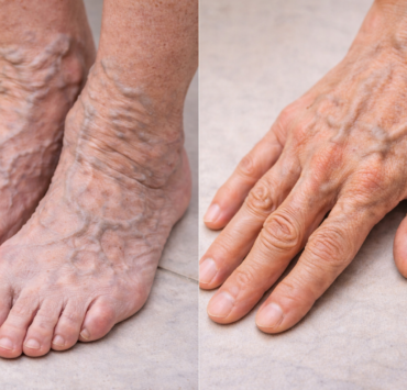 ChatGPT Image 24 dec. 2025 10 59 06 Si tes veines sont gonfl&eacute;es, voici ce que &ccedil;a peut indiquer...