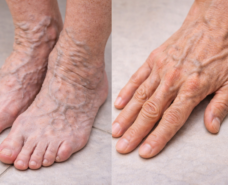 ChatGPT Image 24 dec. 2025 10 59 06 Si tes veines sont gonfl&eacute;es, voici ce que &ccedil;a peut indiquer...