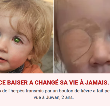 Capture decran 2026 01 30 082101 Herp&egrave;s oculaire : Juwan, 2 ans, perd la vue apr&egrave;s une contamination