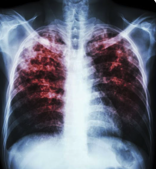 Santé publique en alerte: la tuberculose progresse dans plusieurs régions vérifier si votre région est touchée 2 Santé publique en alerte: la tuberculose progresse dans plusieurs régions vérifier si votre région est touchée Capture le 2026 01 26 a 01.28.18 Santé publique en alerte: la tuberculose progresse dans plusieurs régions vérifier si votre région est touchée