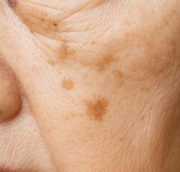 La vaseline pourrait transformer votre peau, découvrez comment 4 La vaseline pourrait transformer votre peau, découvrez comment taches 800x800 1 La vaseline pourrait transformer votre peau, découvrez comment