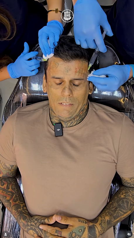 L’homme le plus tatoué fait enlever ses 177 tatouages et change totalement de visage 4 L’homme le plus tatoué fait enlever ses 177 tatouages et change totalement de visage Capture decran 2026 02 28 171610 L’homme le plus tatoué fait enlever ses 177 tatouages et change totalement de visage