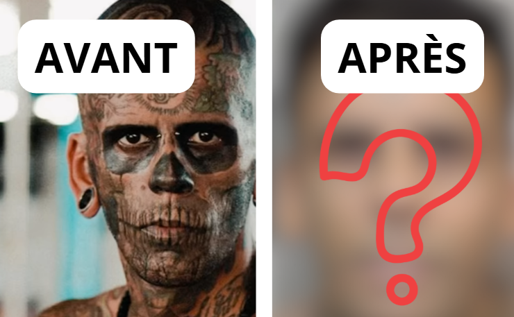 Capture decran 2026 02 28 172500 e1772317914271 L&rsquo;homme le plus tatou&eacute; fait enlever ses 177 tatouages et change totalement de visage