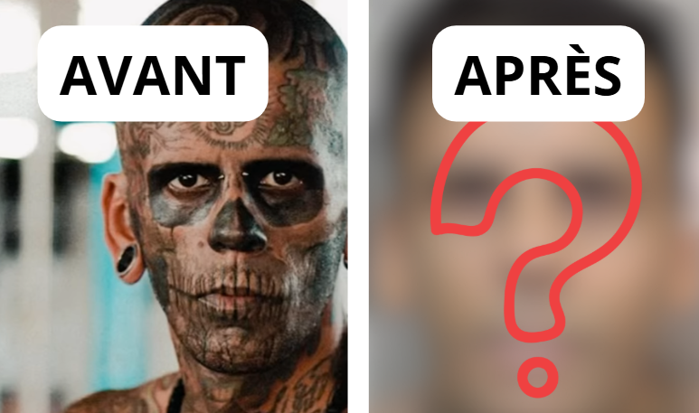 Capture decran 2026 02 28 172500 e1772317914271 L&rsquo;homme le plus tatou&eacute; fait enlever ses 177 tatouages et change totalement de visage