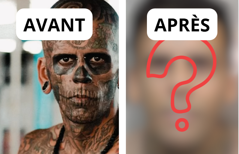 Capture decran 2026 02 28 172500 L&rsquo;homme le plus tatou&eacute; fait enlever ses 177 tatouages et change totalement de visage