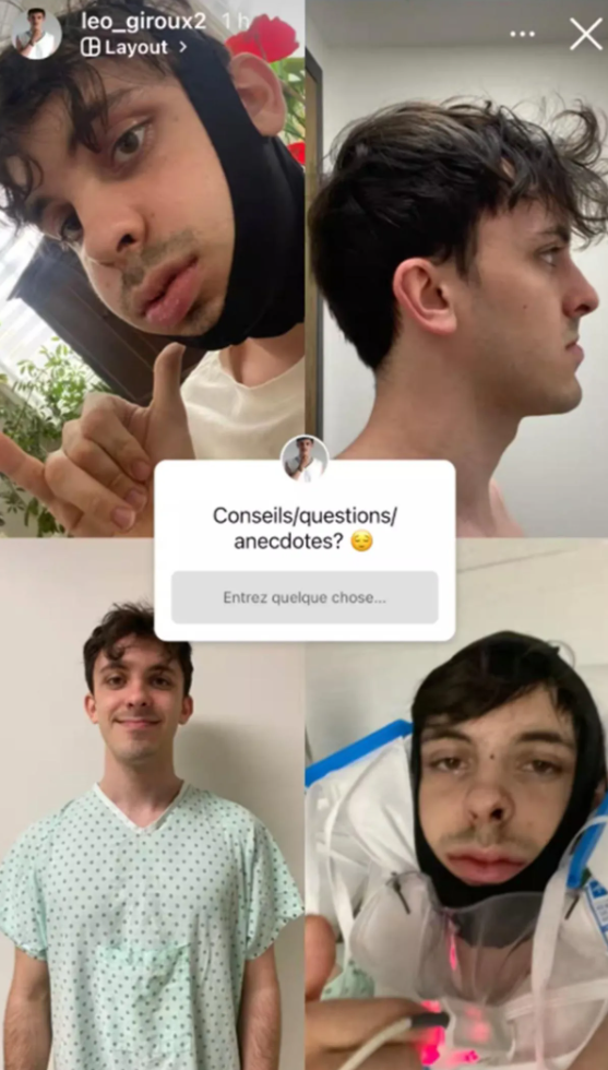 Capture decran 2026 03 17 121521 L&eacute;o Giroux transform&eacute; apr&egrave;s une chirurgie majeure&hellip; sa nouvelle apparence fait r&eacute;agir