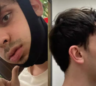 Capture decran 2026 03 17 121528 L&eacute;o Giroux transform&eacute; apr&egrave;s une chirurgie majeure&hellip; sa nouvelle apparence fait r&eacute;agir