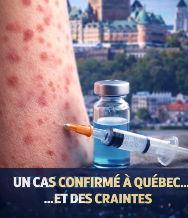 Capture decran 2026 04 09 153735 Rougeole &agrave; Qu&eacute;bec : un premier cas confirm&eacute;&hellip; et une inqui&eacute;tude qui monte rapidement