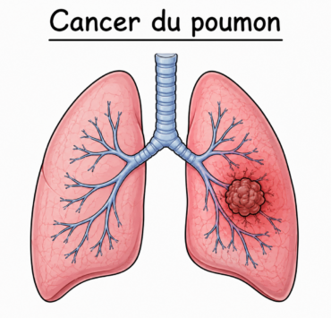 cancer Cancer du poumon : 5 sympt&ocirc;mes surprenants &agrave; surveiller