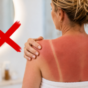 ChatGPT Image 1 aout 2026 19 58 55 L'erreur la plus fr&eacute;quente apr&egrave;s un coup de soleil, selon des experts